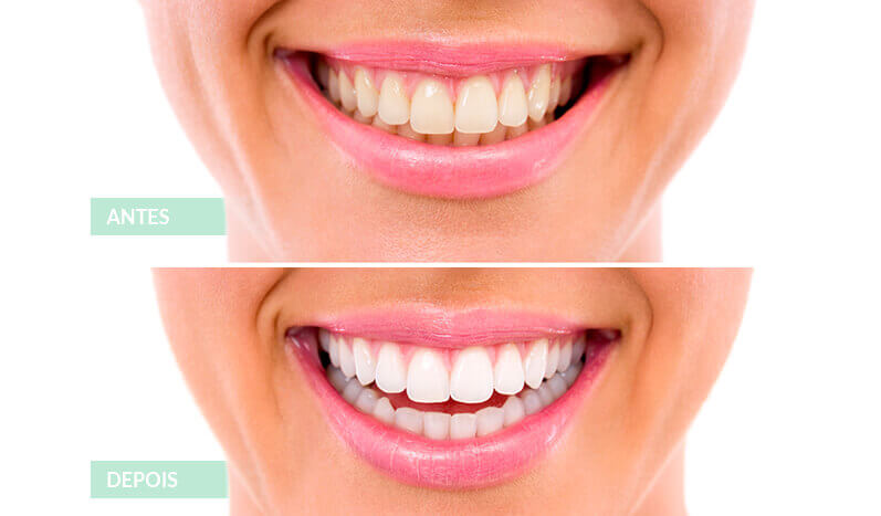 Antes e Depois branqueamento dentario