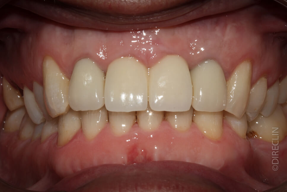Direclin - Implante Dentário Incisivos
