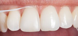 fio-dentario-higiene-oral