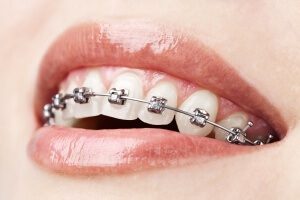 Orthodontics-Occlusion