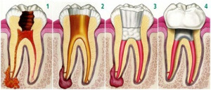Endodontics-devitalization