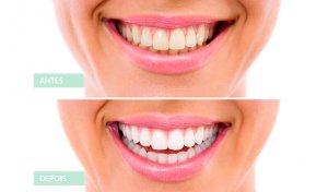 Antes e Depois branqueamento dentario