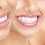 Branqueamento Dentario : Sim ou Não?