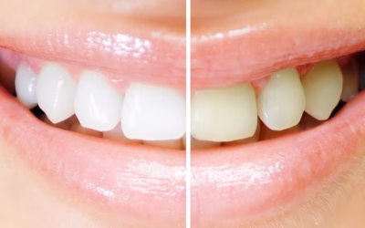 Branqueamento Dentário – Saiba Como Branquear os Dentes Sem Complicações