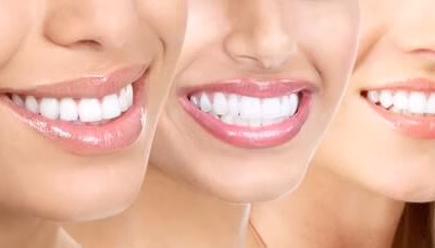 Branqueamento Dentário – Sim ou Não?