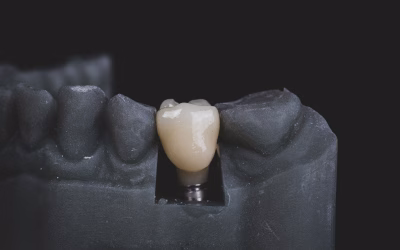 Qualquer pessoa pode colocar implantes dentários?